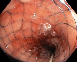 Hình ảnh trực tràng đã được đặt stent thành công