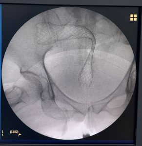 Hình ảnh trực tràng đã được đặt stent thành công