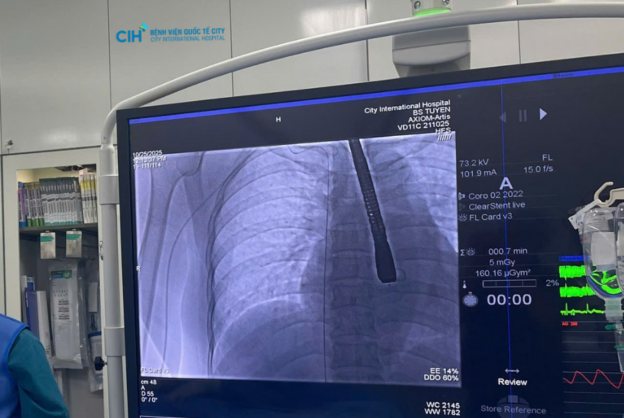 Nong van hai lá bằng bóng qua da được xem là giải pháp can thiệp ít xâm lấn, rút ngắn thời gian hồi phục so với phẫu thuật mở thay van tim truyền thống.