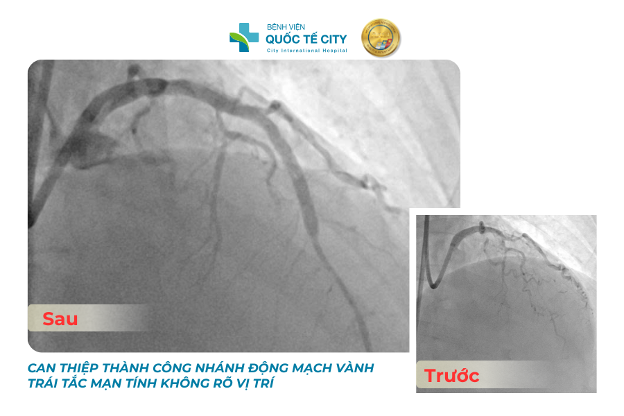 Can thiệp thành công ca nhồi máu cơ tim nguy kịch, tổn thương hai nhánh vành 1 4