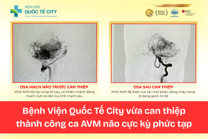 Hình ảnh DSA mạch não trước và sau can thiệp cho thấy khối AVM não phức tạp đã được xử trí thành công, dòng chảy dị dạng giảm rõ rệt.