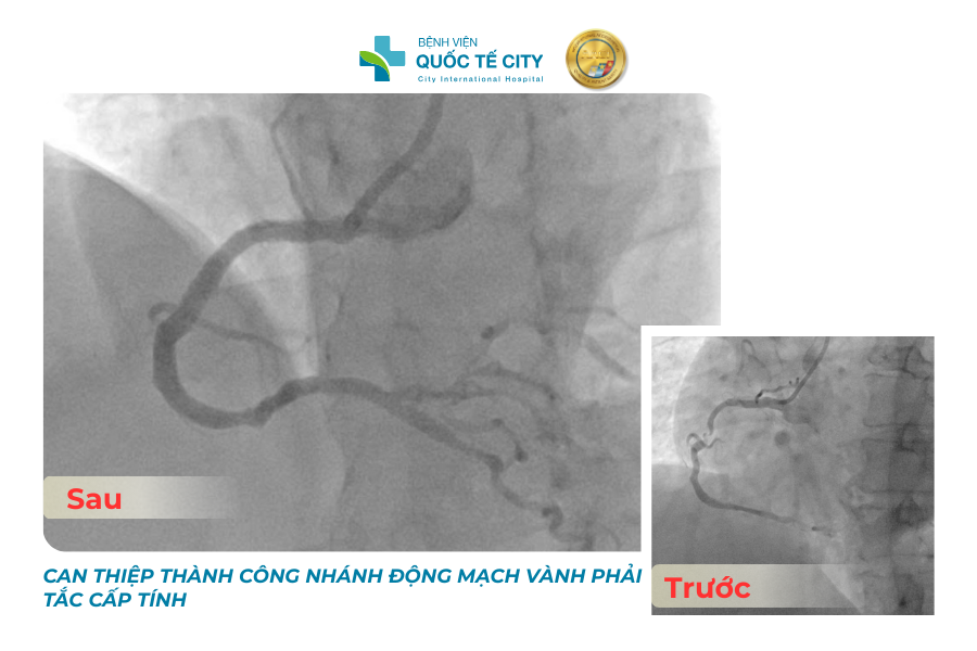 Can thiệp thành công ca nhồi máu cơ tim nguy kịch, tổn thương hai nhánh vành 2 Kết quả chụp mạch vành cho thấy bệnh nhân bị tắc hoàn toàn động mạch vành phải cấp tính và tắc mạn tính động mạch vành trái kèm vôi hóa nặng – một tổn thương hiếm gặp và cực kỳ phức tạp.