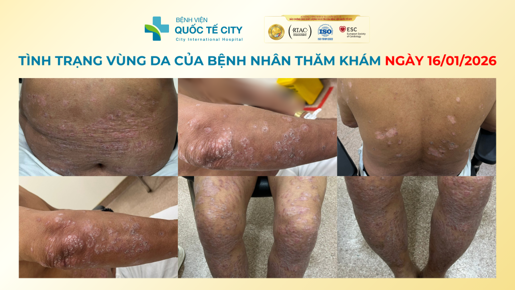 Tình trạng da của bệnh nhân vào ngày đầu tiên đến Bệnh viện Quốc tế City thăm khám
