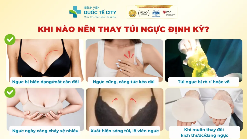 Thay túi ngực càng sớm nếu gặp các dấu hiệu sau
