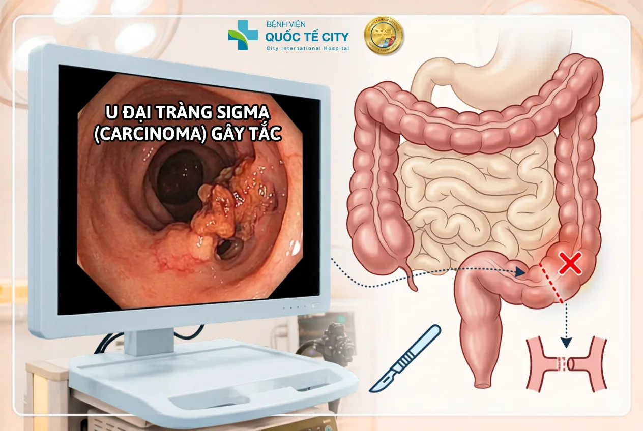Các bác sĩ cho biết, nhiều bệnh nhân ung thư đại tràng thường nhập viện muộn do chủ quan với các triệu chứng ban đầu