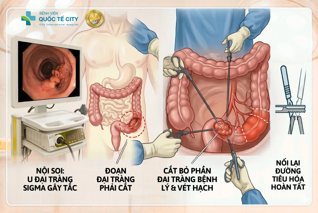 Bác sĩ quyết định chỉ định phẫu thuật cắt đoạn đại tràng sigma nhằm loại bỏ khối u và xử lý tình trạng hẹp tắc lòng ruột