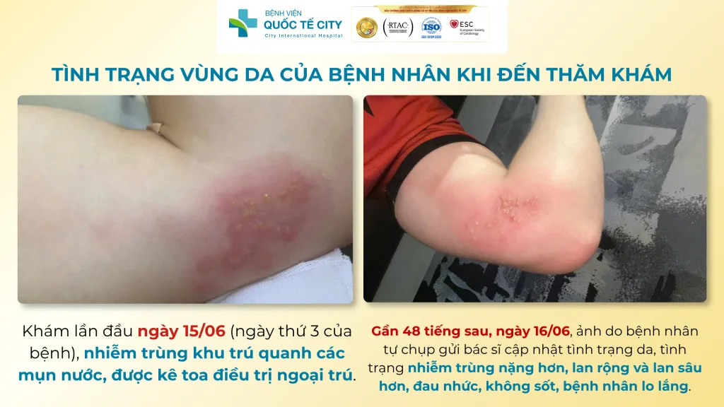 Biến chứng Zona tiến triển chỉ sau gần 48 giờ