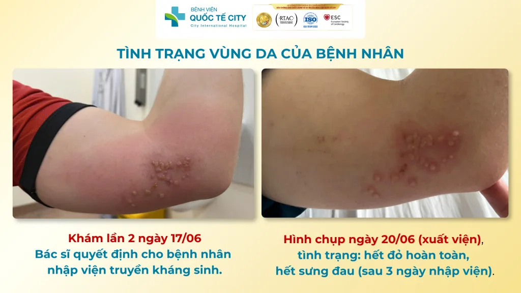 Biến chứng Zona được điều trị kịp thời giúp kiểm soát biến chứng 