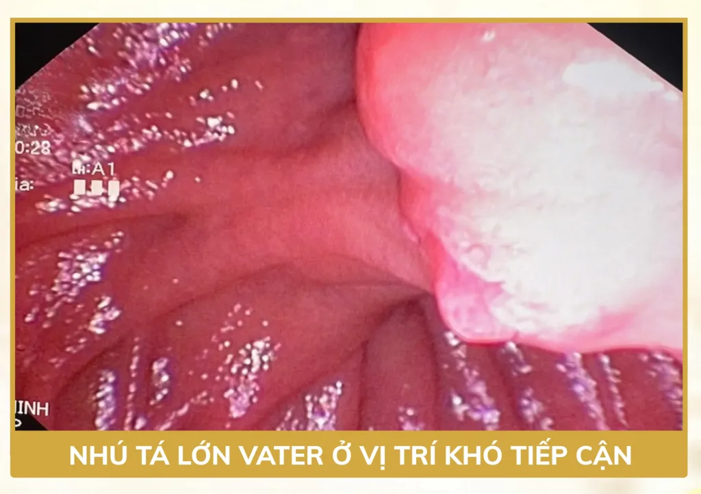 Hình ảnh nội soi nhú tá lớn Vater trong quá trình ERCP