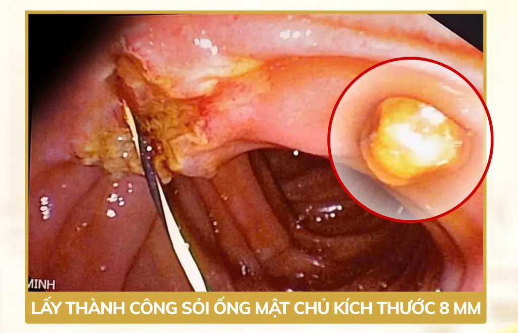 Hình ảnh lấy sỏi ống mật chủ kích thước khoảng 8 mm qua nội soi ERCP