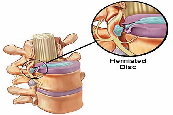 How a herniated disc can affect your life