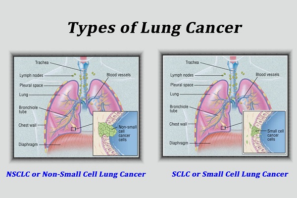 How to Detect Lung Cancer before It’s Too Late