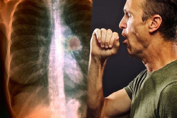 Early Signs of Lung Cancer