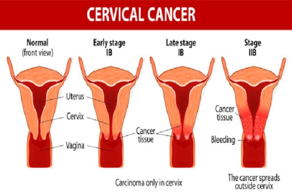 Screeningul cancerului de col uterin