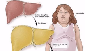 beo phi va tieu duong dan den ung thu gan 66f82af4a64c5