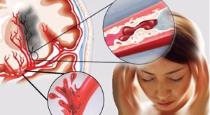 trieu chung dien hinh canh bao mach mau bi tac 66f81b6e8020c